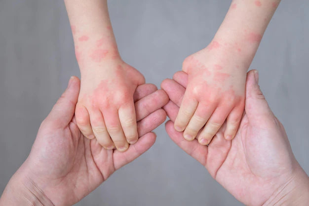 How to Treat Eczema in Babies & Toddlers? - omumsie