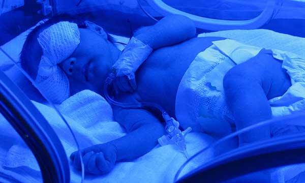 Phototherapy for Jaundice in Newborns: A Comprehensive Guide for Parents