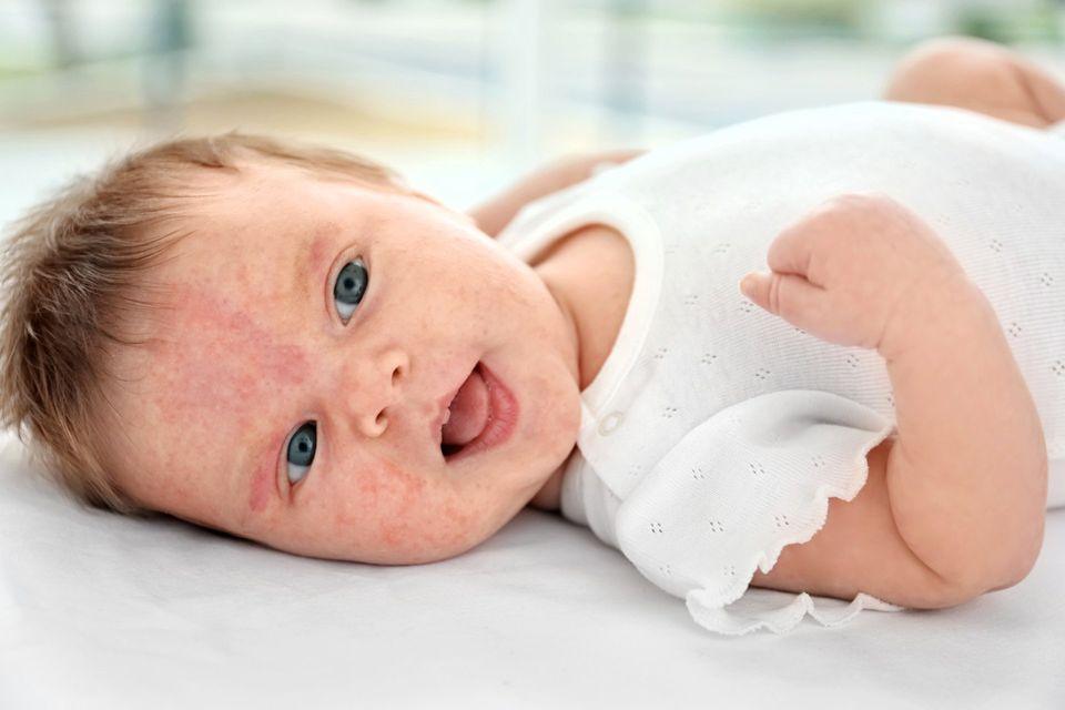 What to Expect When Your Baby Has Allergies - omumsie